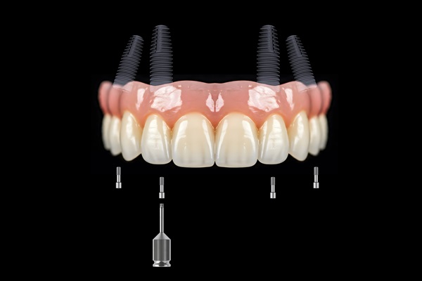 How Long Does It Take To Get Implant Supported Dentures?